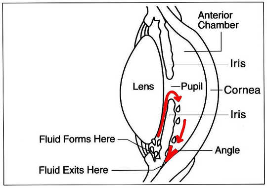 glaucoma