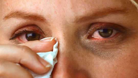 What Is Conjunctivitis And How Did I Get It?