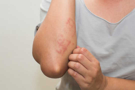 Common Skin Rashes And What To Do About Them