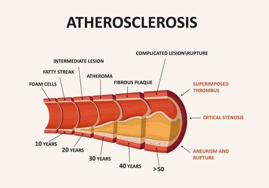 Alzheimer's Disease Is Not Linked To Type 2 Diabetes Or High Blood Pressure