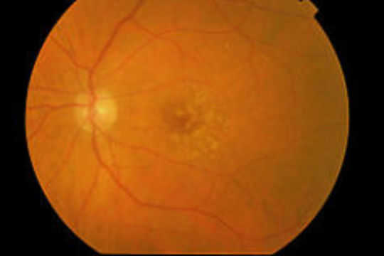 Age-Related Macular Degeneration Explained