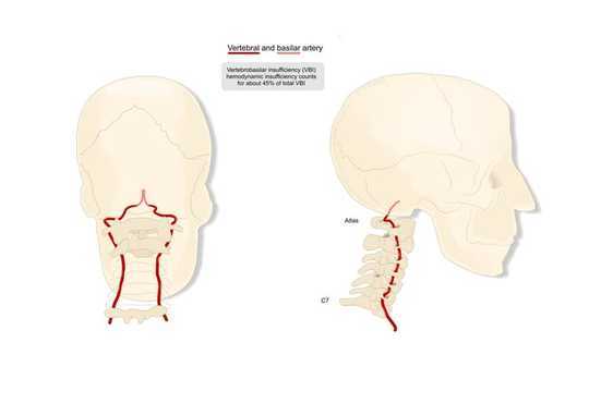 Can Popping Your Neck Cause A Stroke?