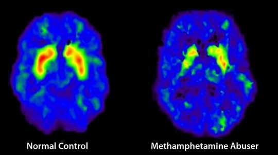 Dopamine Fasting: An Expert Reviews The Latest Craze