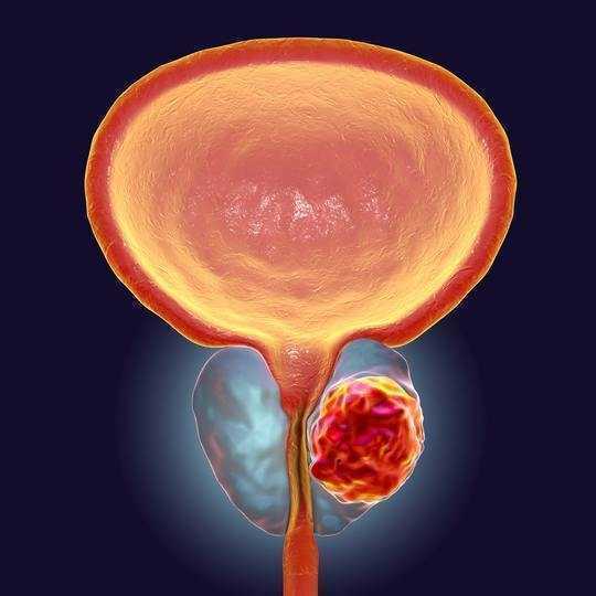 Why PSA Testing For Prostate Cancer Is Only Worth It For Some