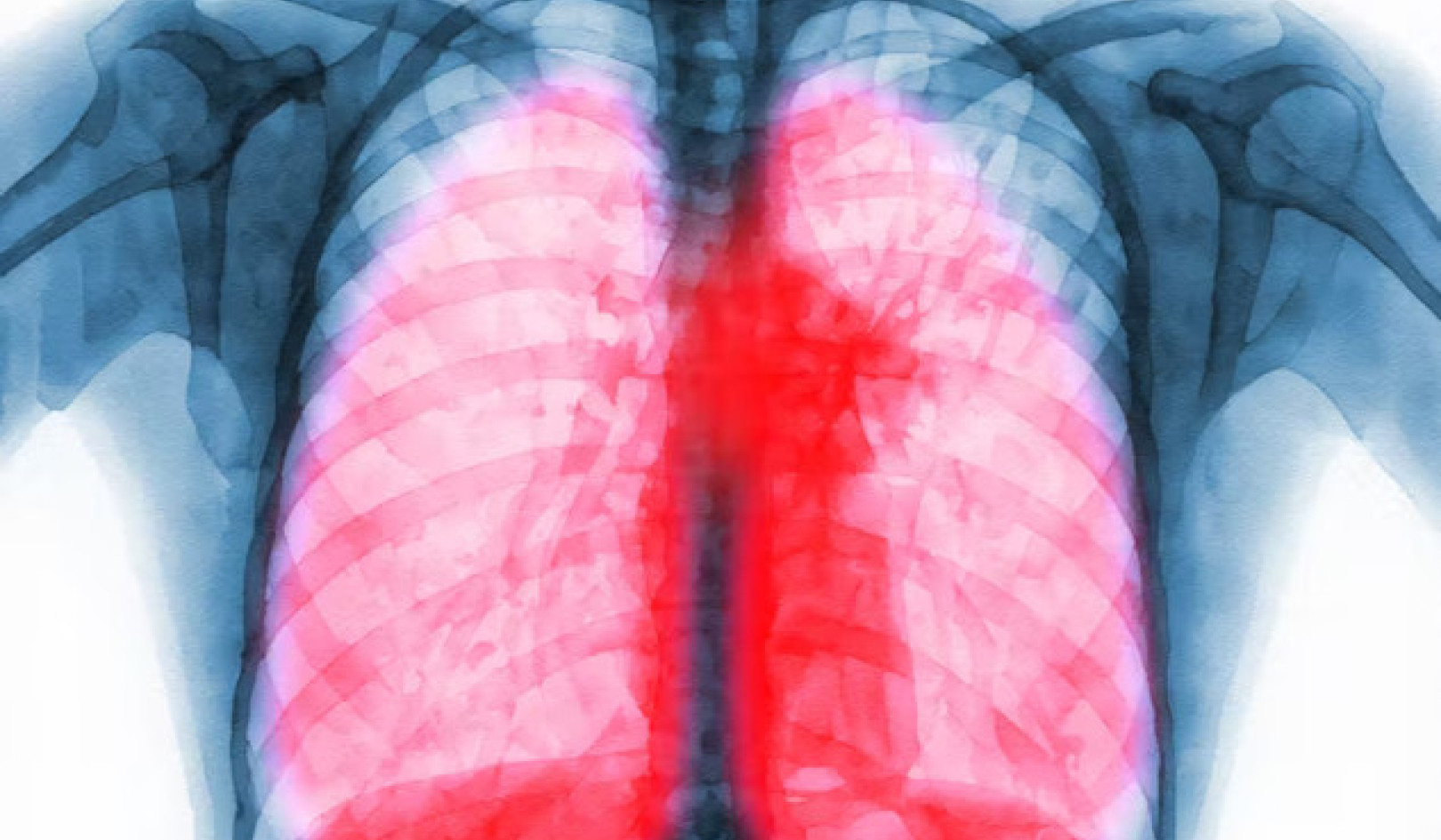 Long COVID inflicts deep scars on the lungs, but targeting specific immune cells could reverse damage