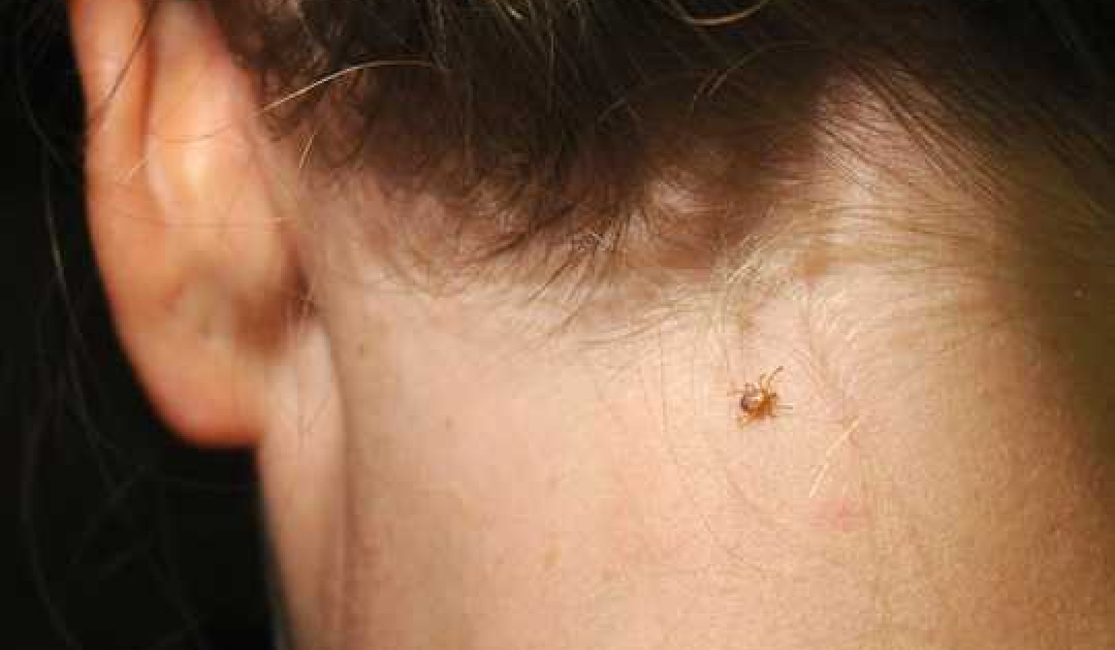 Ticks Spread Plenty More Than Lyme Disease