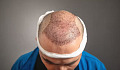 A doctor performing hair transplant surgery, showing precision in handling grafts to ensure minimal risk and optimal recovery.