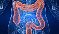 Can Screwy Gut Bacteria Raise Your Diabetes Risk?