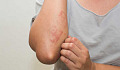 Common Skin Rashes And What To Do About Them