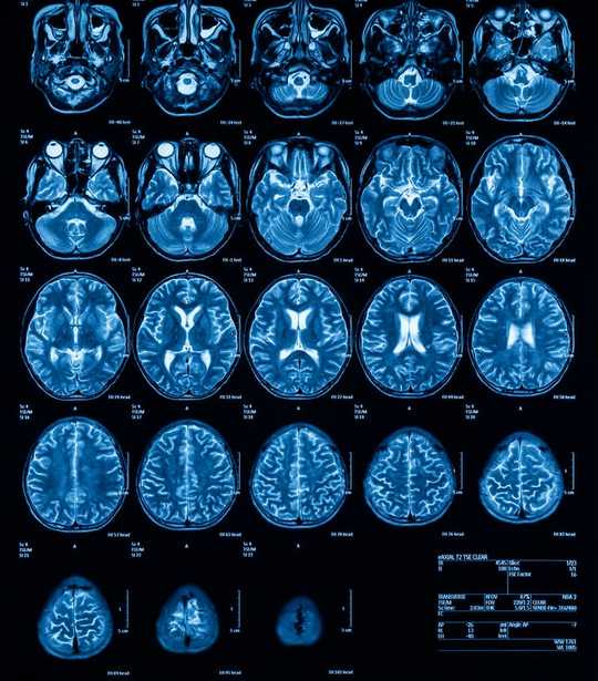 Blindsight: A Strange Neurological Condition That Could Help Us Explain Consciousness